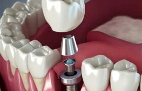 تبلیغ ایمپلنت فوری دروغ است/ سلبریتی‌ها حق تبلیغ خدمات پزشکی را ندارند