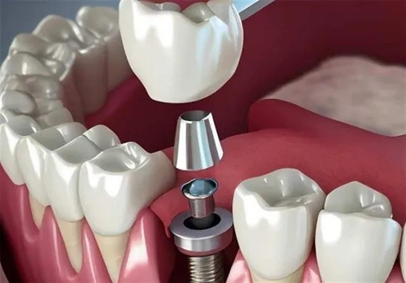 تبلیغ ایمپلنت فوری دروغ است/ سلبریتی‌ها حق تبلیغ خدمات پزشکی را ندارند
