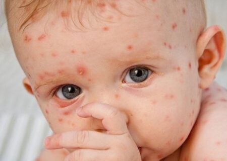 شیوع «آبله مرغان» در بهار