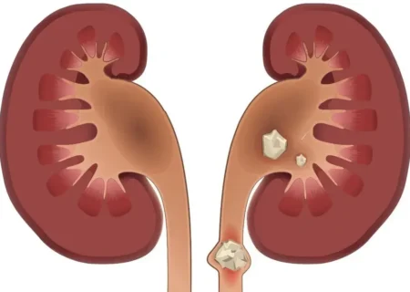 سنگ کلیه چه علائمی دارد؟
