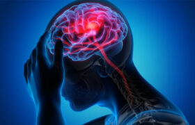 تحریک نخاع به بازیابی قدرت بازو پس از سکته مغزی کمک می کند