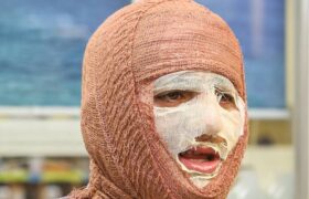 «جان نو» به کمک بیماران سوختگی می‌آید