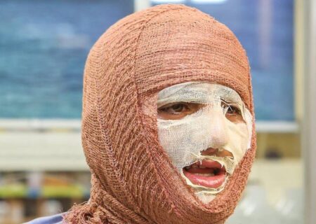 «جان نو» به کمک بیماران سوختگی می‌آید